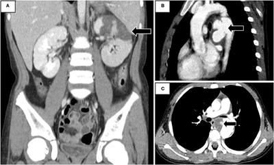 Case Report: Acute Renal Infarction in a Child With Coarctation of Aorta